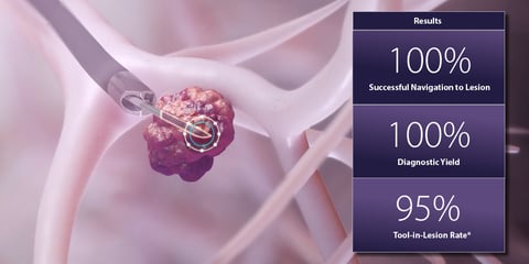 Journal of Bronchology & Interventional Pulmonology Publishes MATCH Study Results Confirming “Tool-in-Lesion” Accuracy of Noah Medical’s Galaxy System